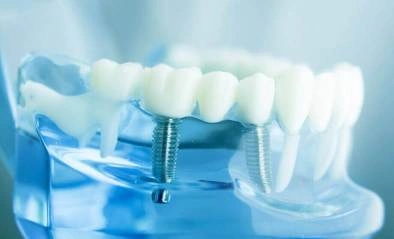 インプラント・インプラント周囲炎