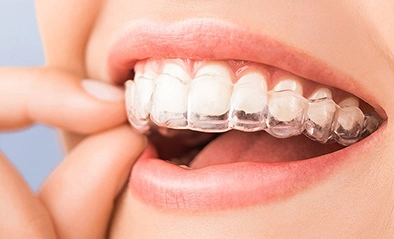 マウスピース矯正治療